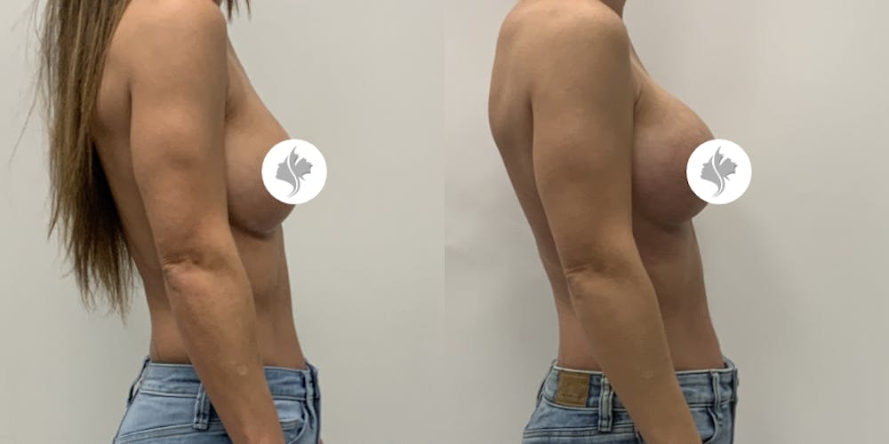This is one of our beautiful breast augmentation patient #66