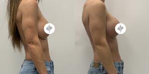 This is one of our beautiful patient 66 patient 66