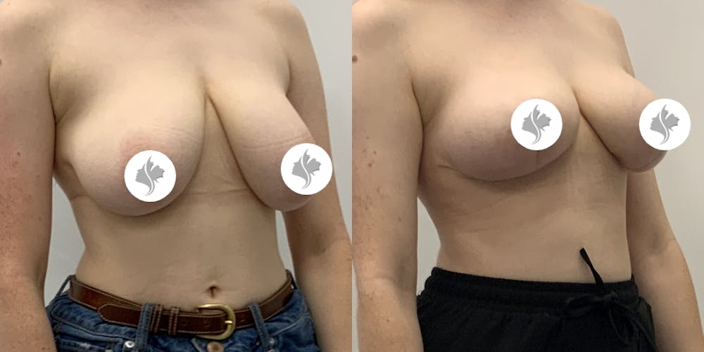 This is one of our beautiful breast reduction patient #1