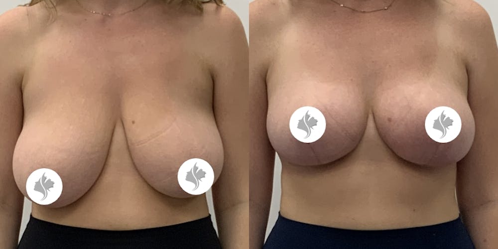 This is one of our beautiful breast reduction patient #95