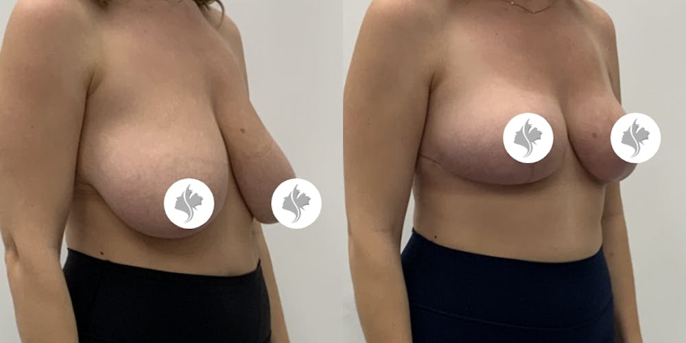 This is one of our beautiful breast reduction patient #95