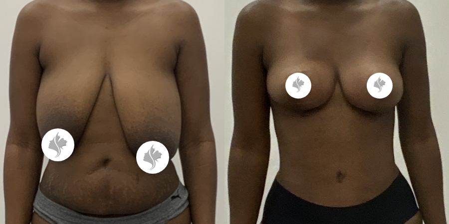 This is one of our beautiful breast reduction patient 100