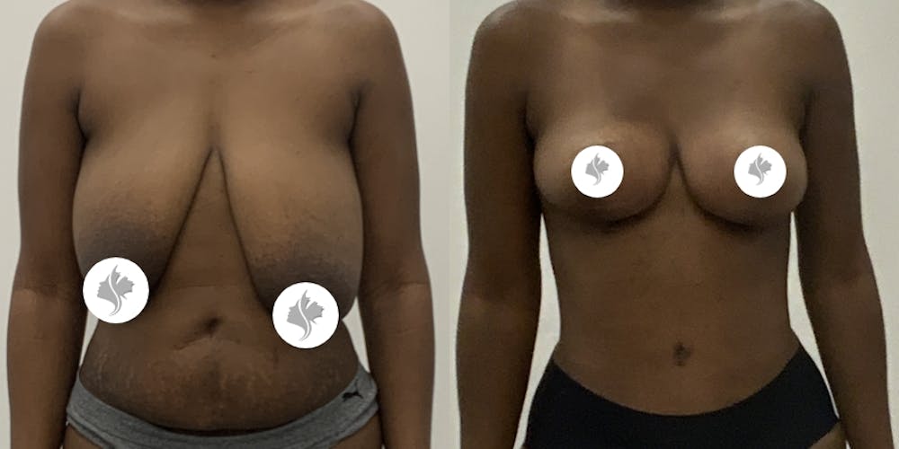 This is one of our beautiful breast reduction patient #100