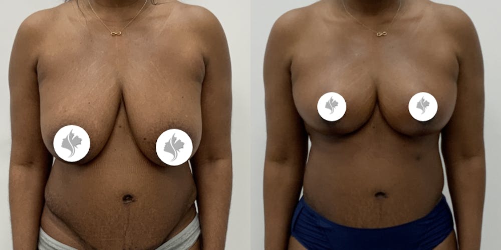 This is one of our beautiful breast reduction patient #101