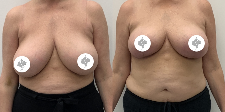 This is one of our beautiful breast reduction patient 94
