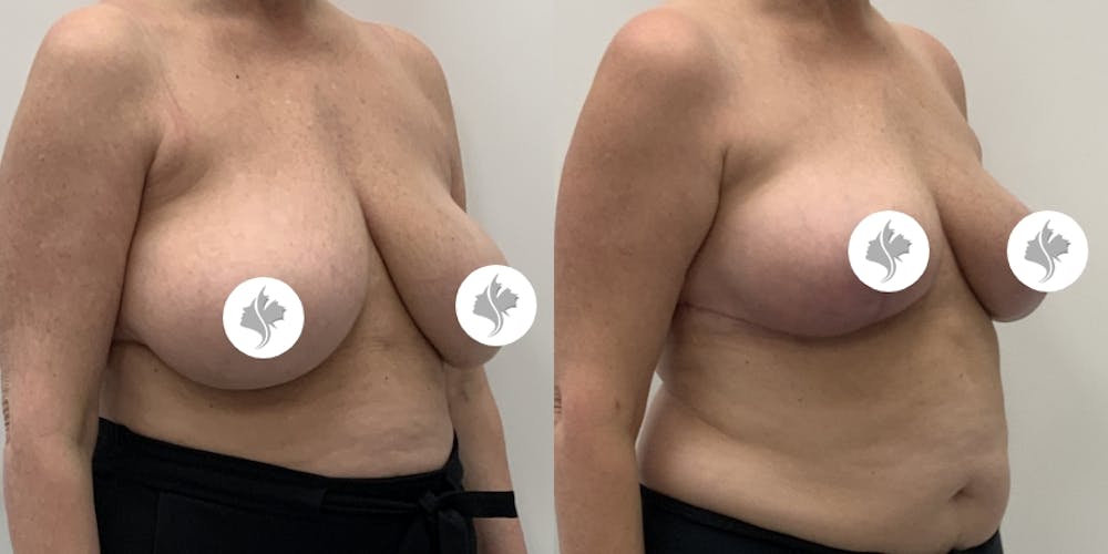 This is one of our beautiful breast reduction patient #94