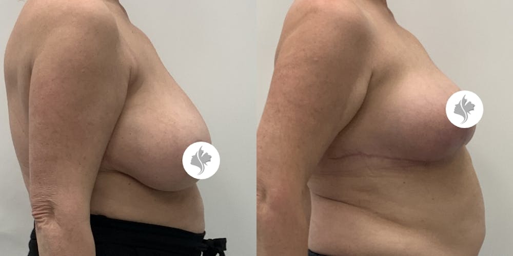 This is one of our beautiful breast reduction patient #94