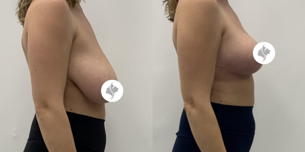 This is one of our beautiful breast reduction patient #95