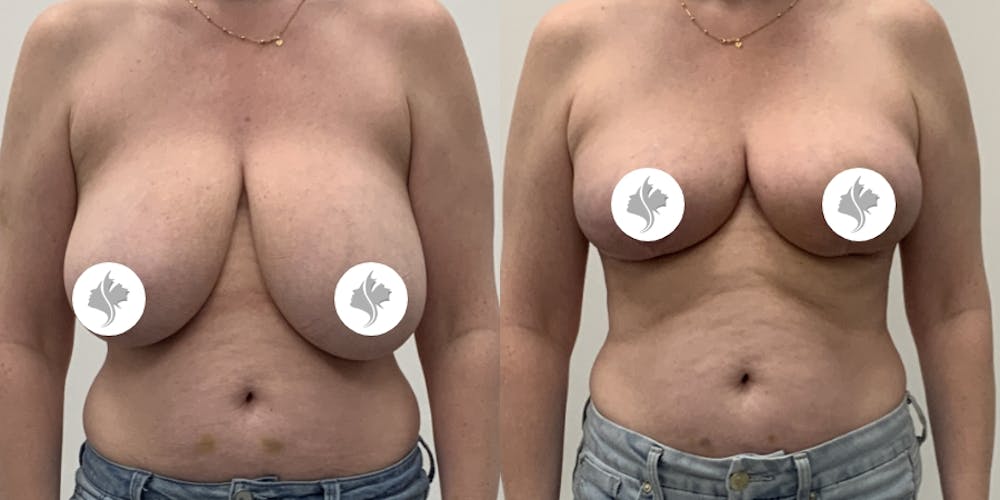This is one of our beautiful breast reduction patient #96