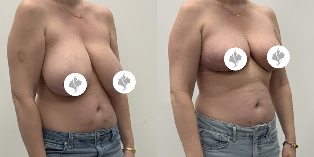 This is one of our beautiful breast reduction patient #96