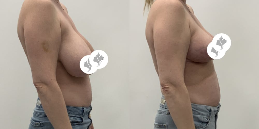 This is one of our beautiful breast reduction patient #96