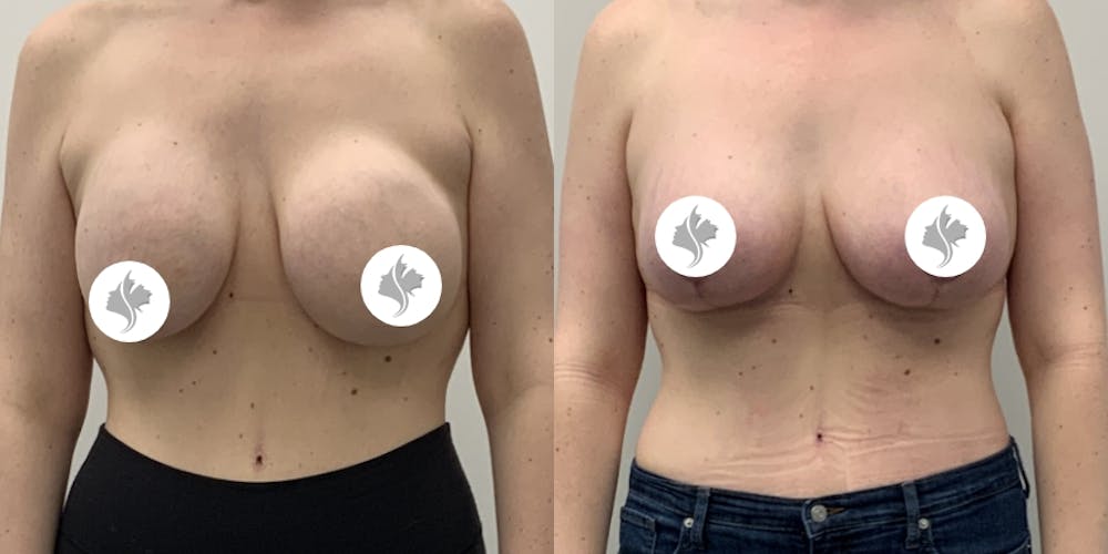 This is one of our beautiful breast reduction patient #98