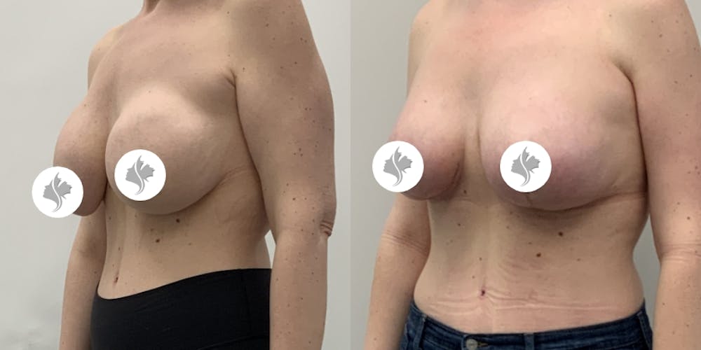 This is one of our beautiful breast reduction patient #98