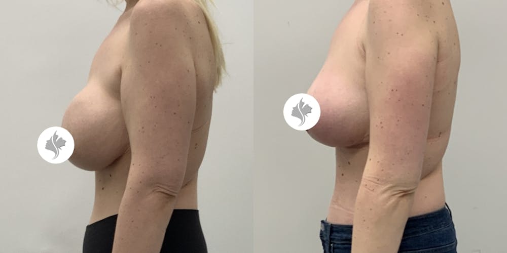 This is one of our beautiful breast reduction patient #98