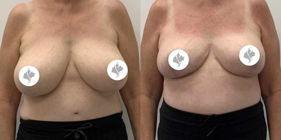 This is one of our beautiful breast reduction patient 99