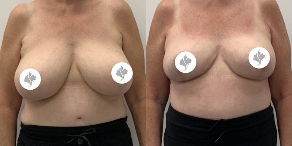 This is one of our beautiful breast reduction patient #99