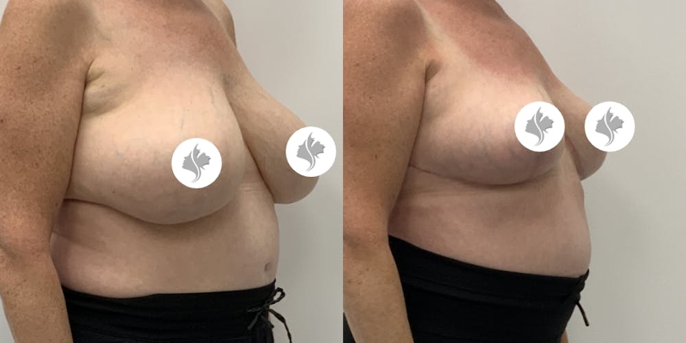 This is one of our beautiful breast reduction patient #99