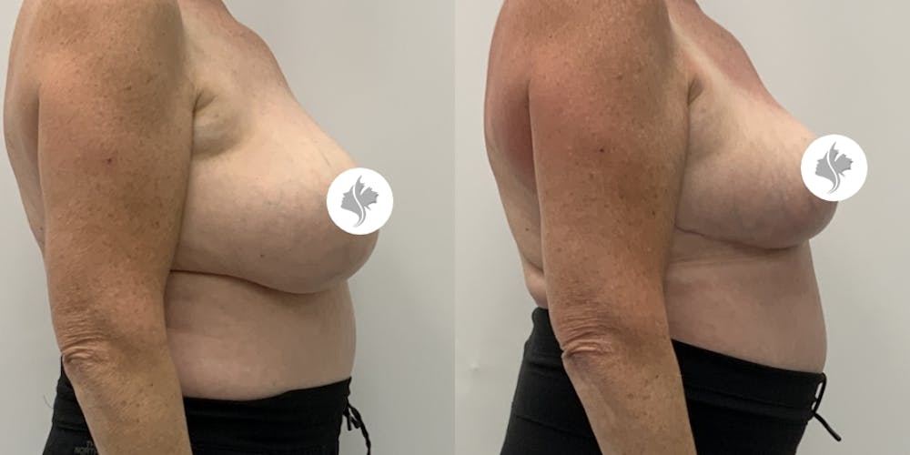 This is one of our beautiful breast reduction patient #99
