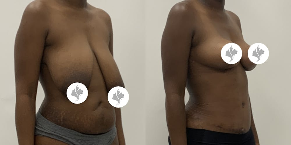 This is one of our beautiful breast reduction patient #100