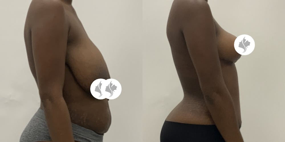This is one of our beautiful breast reduction patient #100