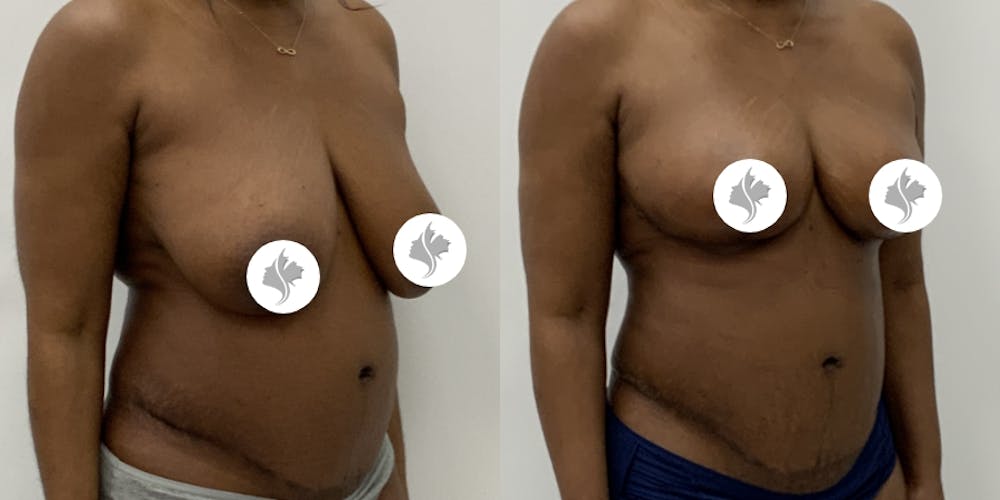 This is one of our beautiful breast reduction patient #101