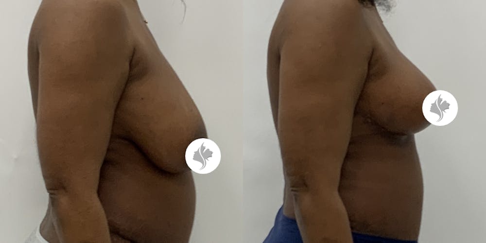 This is one of our beautiful breast reduction patient #101