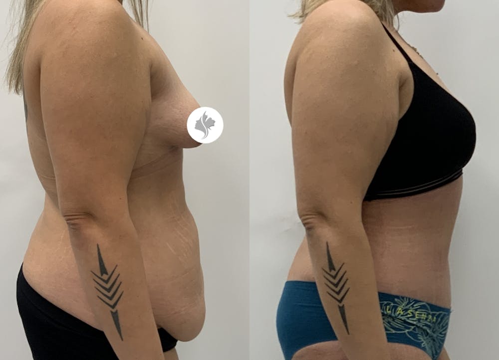 This is one of our beautiful tummy tuck patient #4