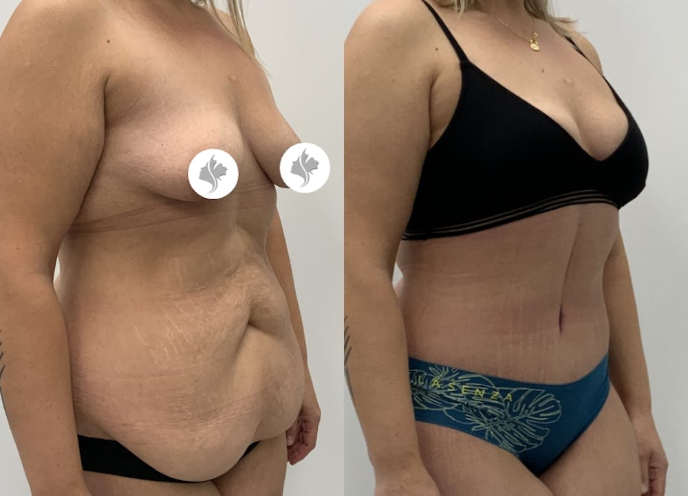 This is one of our beautiful tummy tuck patient #4