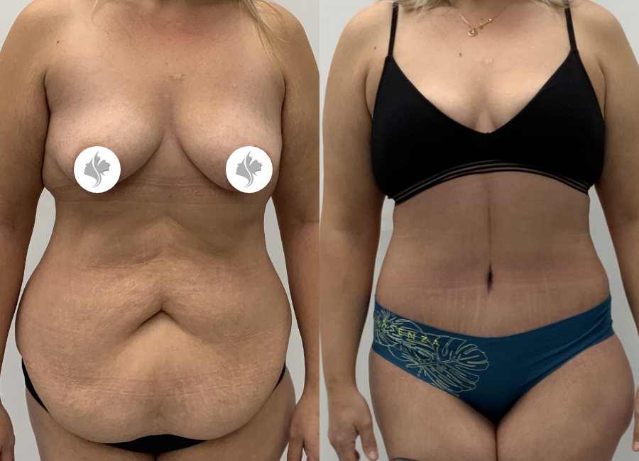 This is one of our beautiful tummy tuck patient 4