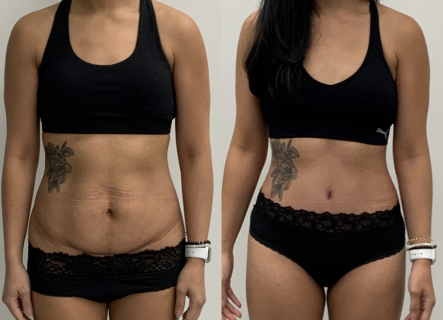 This is one of our beautiful tummy tuck patient 2