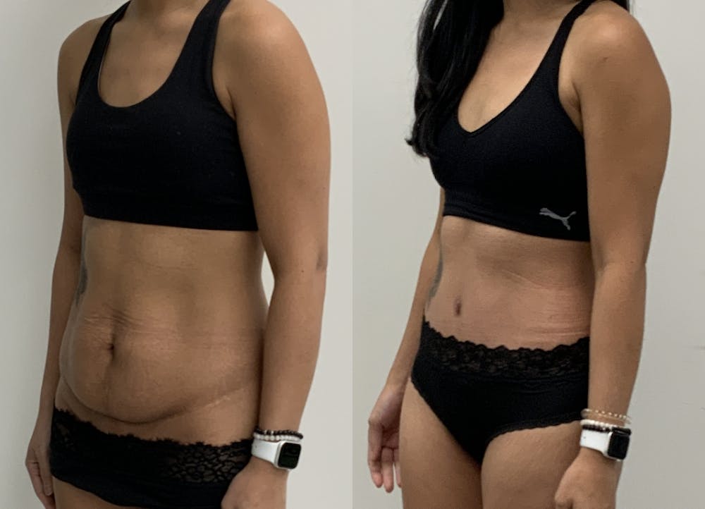 This is one of our beautiful tummy tuck patient #2
