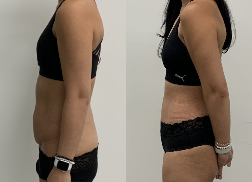 This is one of our beautiful tummy tuck patient #2