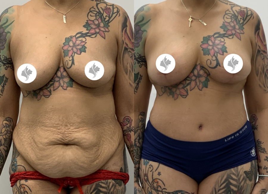 This is one of our beautiful tummy tuck patient 9
