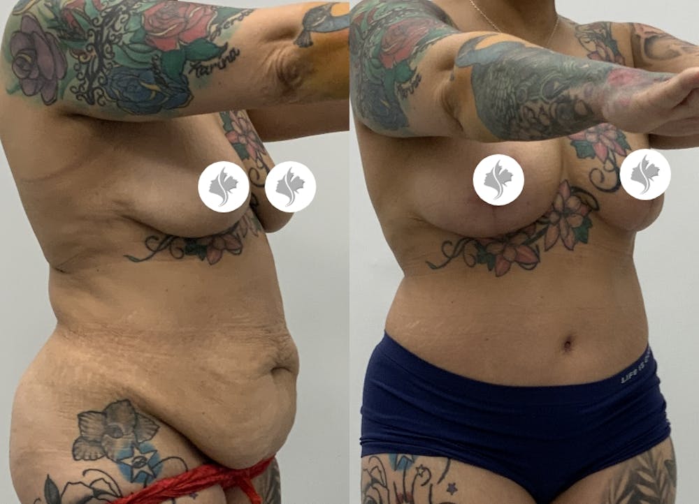 This is one of our beautiful tummy tuck patient #9