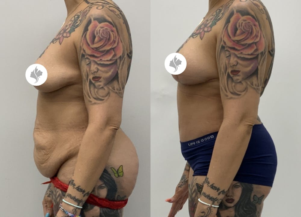 This is one of our beautiful tummy tuck patient #9