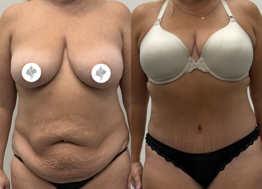 This is one of our beautiful tummy tuck patient #118
