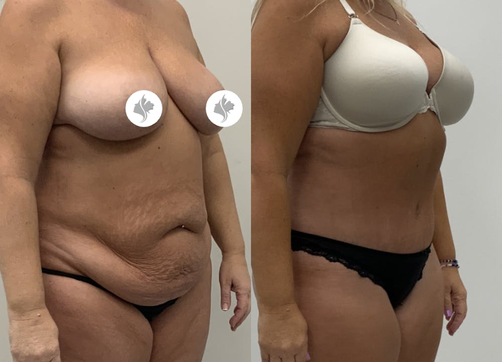 This is one of our beautiful tummy tuck patient #118