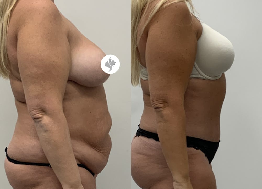 This is one of our beautiful tummy tuck patient #118