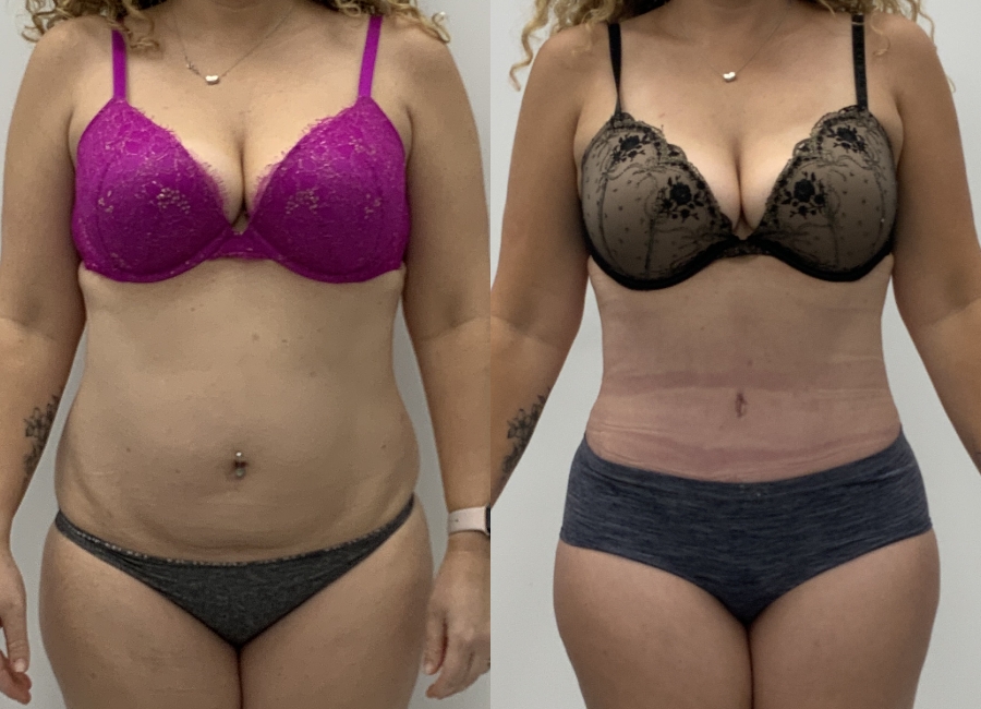 This is one of our beautiful tummy tuck patient 8