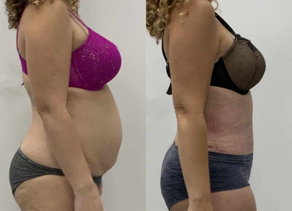 This is one of our beautiful tummy tuck patient #8