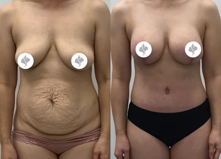 This is one of our beautiful tummy tuck patient 13