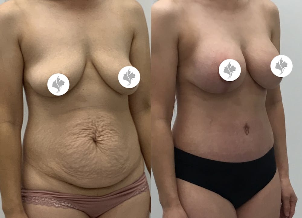 This is one of our beautiful mommy makeover patient #32