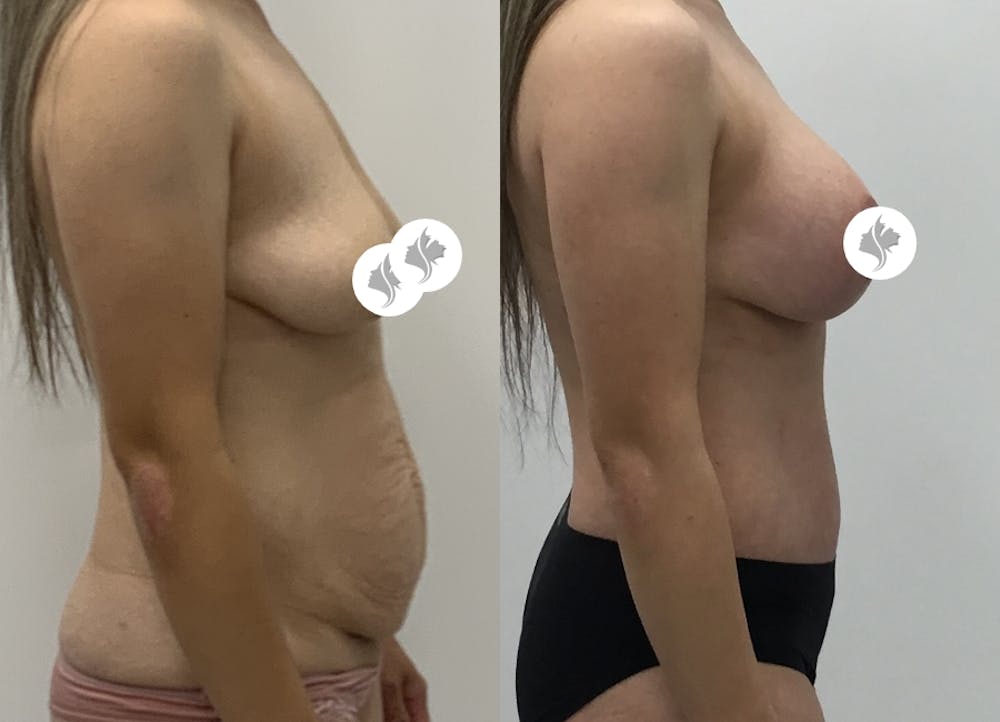 This is one of our beautiful mommy makeover patient #32