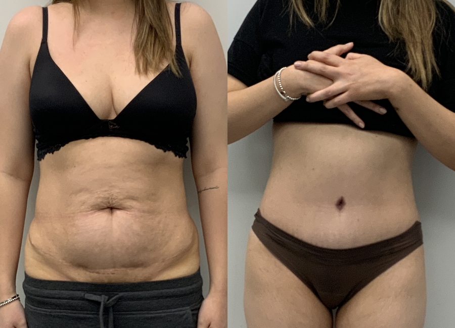 This is one of our beautiful tummy tuck patient 7