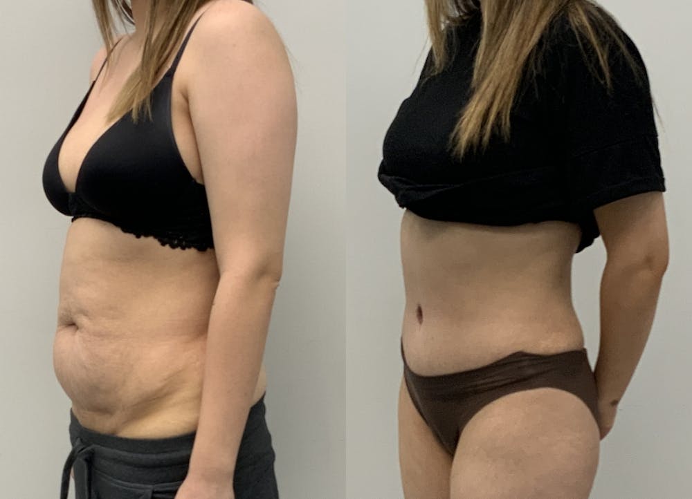 This is one of our beautiful tummy tuck patient #7