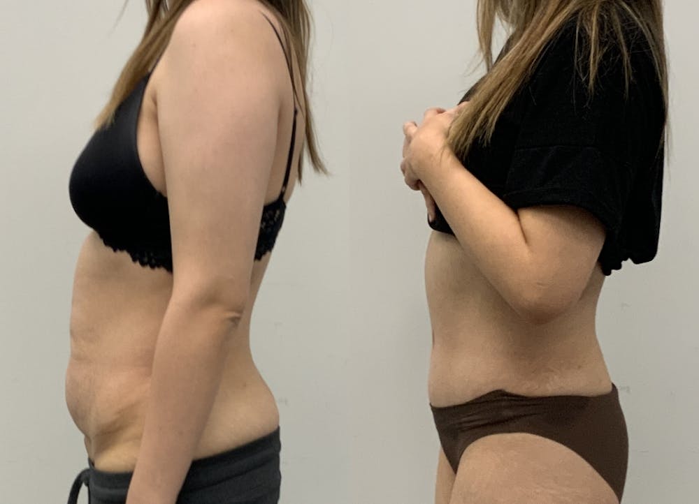 This is one of our beautiful tummy tuck patient #7