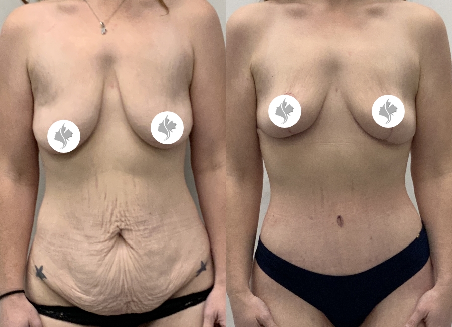This is one of our beautiful tummy tuck patient 3