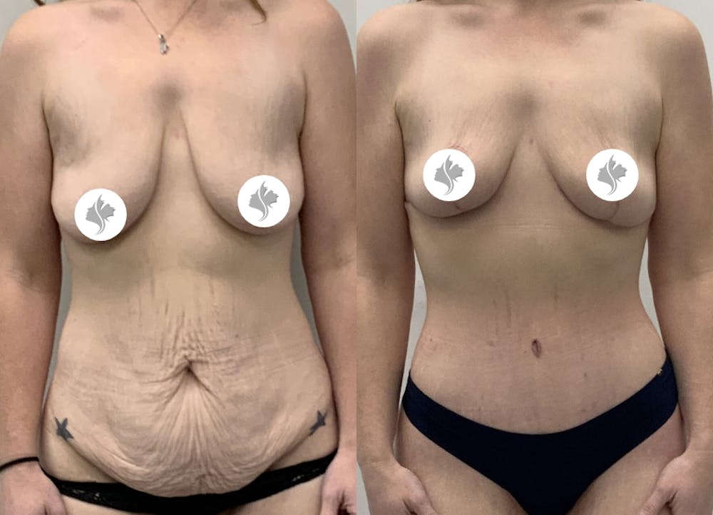 This is one of our beautiful tummy tuck patient #3