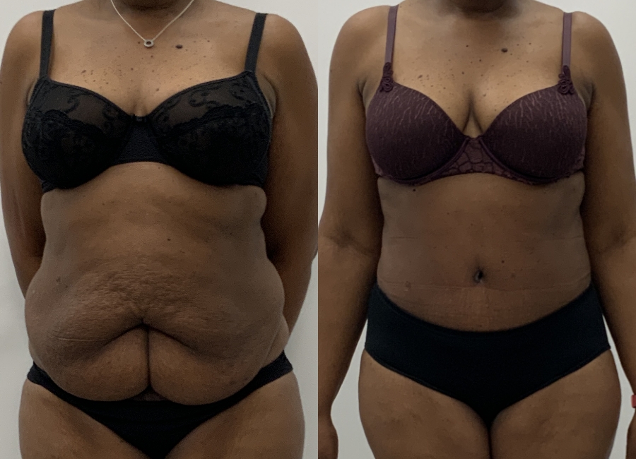 This is one of our beautiful tummy tuck patient 6