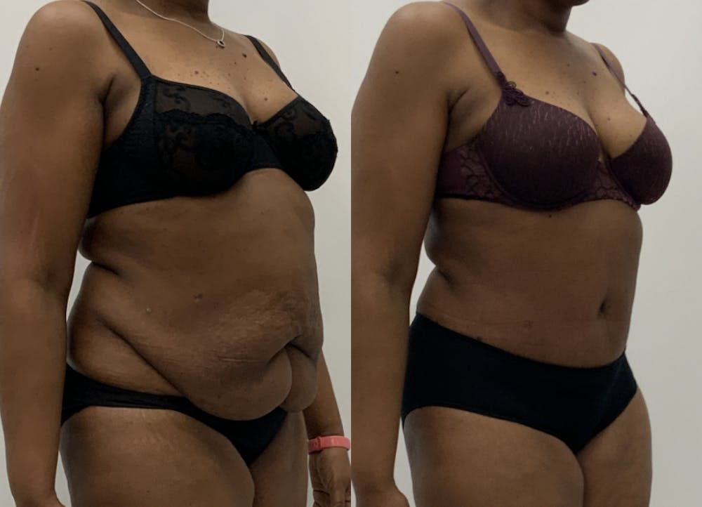 This is one of our beautiful tummy tuck patient #6